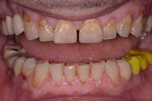 Close-up of mouth showing stained, chipped upper front teeth with a gap between the central incisors and crowded, stained lower teeth with plaque buildup; yellow dental material on the lower right side.