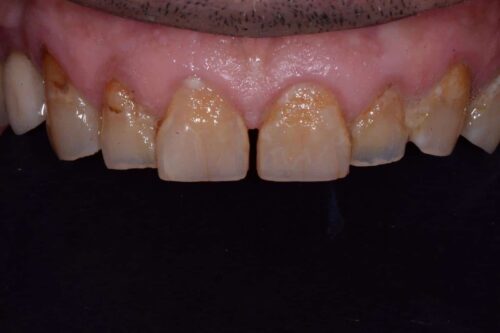 Close-up of the upper front teeth with yellow-brown stains, plaque buildup, and a gap between the central incisors.
