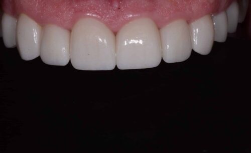 Close-up of the upper front teeth and pink gumline against a dark background.
