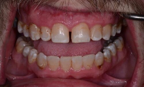 Close-up of an open bite with misaligned, stained teeth and red inflamed gums, showing dental crowding and wear.