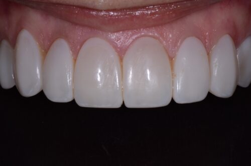 Close-up of the upper front teeth and surrounding gums, showing the gingival margins and enamel surfaces for a dental assessment.