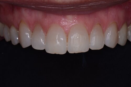 Close-up of the lower front teeth and gum line in the open mouth scenario.