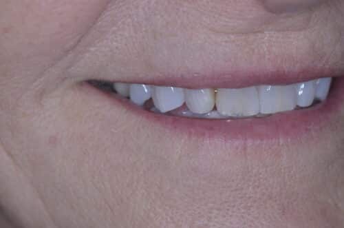 Close-up of a smile showing upper teeth and lips in focus and surrounding skin texture visible.