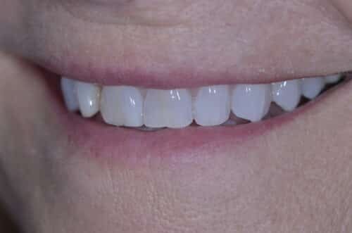 Close-up of a smile revealing the upper front teeth and pink lips on a light-skinned mouth area
