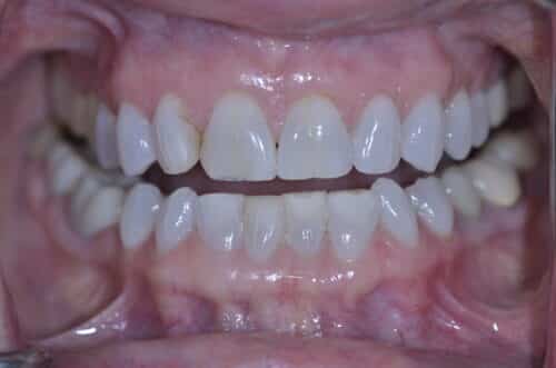 Close-up of a smile showing upper front teeth with mild crowding and pink, healthy-looking gums nearby.