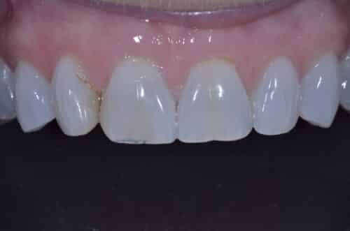 Close-up of the lower front teeth and gums showing mild gingival recession and brown staining along the gumline on the left side.