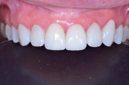 Close-up of upper teeth with uniform white veneers and pink gums.