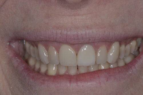 Close-up of a smiling mouth showing upper and lower teeth.