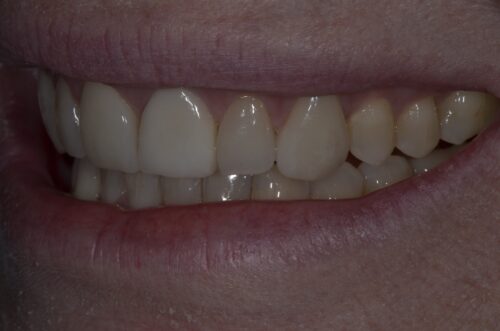 Close-up of a smile showing the upper front teeth and lips, focusing on alignment and gum line.