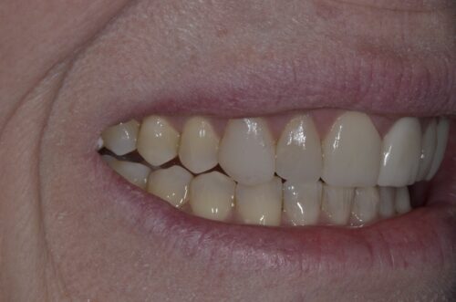 Close-up of a smile showing stained upper and lower teeth with visible gum line and wrinkles around the mouth (dental health focus).