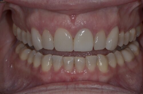 Close-up of an open-mouthed smile showing upper and lower teeth with pink gums and even, white veneers or crowns on the front teeth.