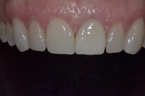 Close-up of upper front teeth with a small gap between the central incisors and pink gum tissue.