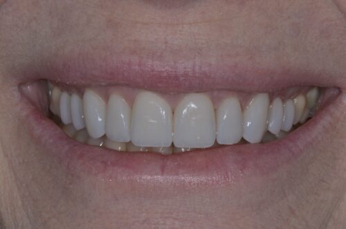 Close-up of a smile showing straight, white teeth with pink lips surrounding them.