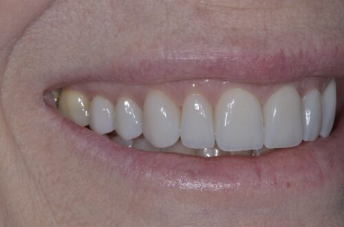 Close-up of a smiling mouth showing the upper teeth and pink lips.