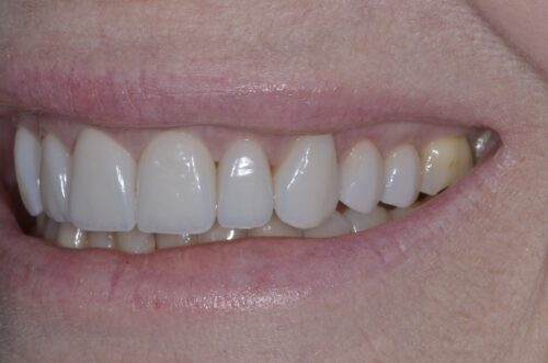 Close-up of a smile showing white front teeth with dental veneers or crowns on the upper row and pink lips nearby for context.