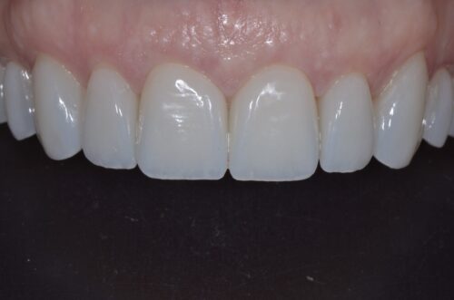 Close-up of the lower front teeth and gumline with clean, white incisors against pink gums.