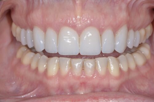Close-up of upper and lower teeth with pink gums, showing dental alignment and clean enamel.