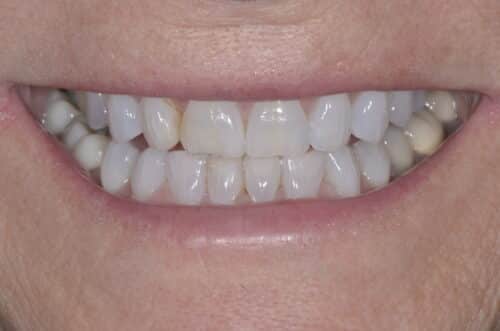 Close-up of a smiling mouth showing upper and lower teeth with mild crowding and slight staining on some teeth.