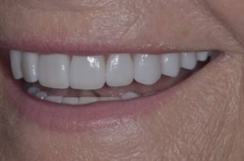 Close-up of a smile showing white, evenly aligned upper teeth with pink lips nearby.