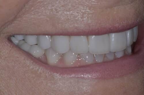 Close-up of a smiling mouth showing upper teeth and lips, with visible dry skin around the mouth.