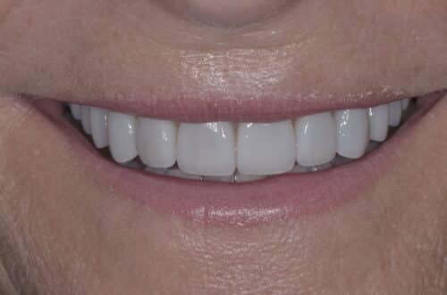 Close-up of a smile showing bright white teeth and pink lips, with the lower part of the face visible mostly around the mouth.