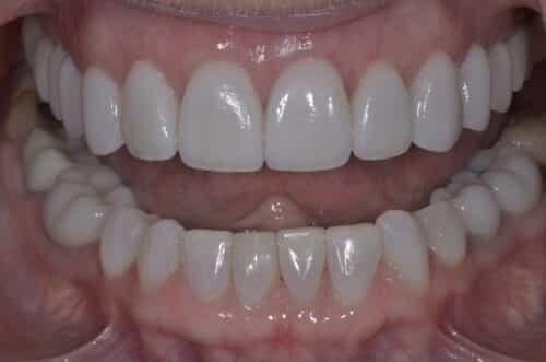 Close-up of a smile showing straight, white teeth with even edges (likely veneers).