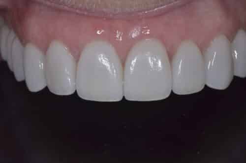 Close-up of the lower front teeth and gumline with pink, healthy-looking gums surrounding evenly aligned white teeth.