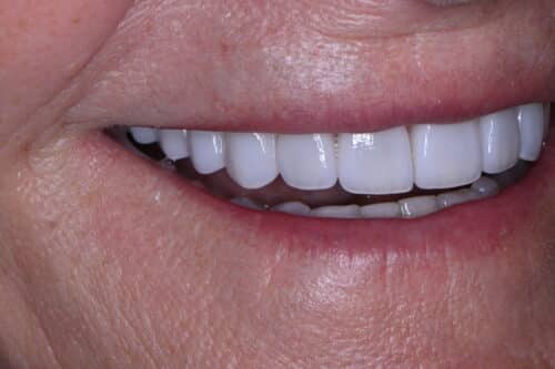 Close-up of a smiling mouth showing bright white dental veneers on upper teeth and surrounding skin textures around the lips.