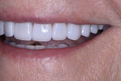 Close-up of a smiling mouth showing straight, white front teeth and pink lips, likely cosmetic dental veneers or crowns on the upper row.