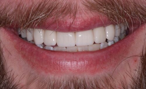 Close-up of a smile showing straight, white teeth with pink gums.