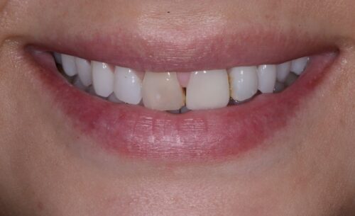 Close-up of a smiling mouth showing chipped front teeth, a small gap between the central incisors, and slight staining near the gum line.