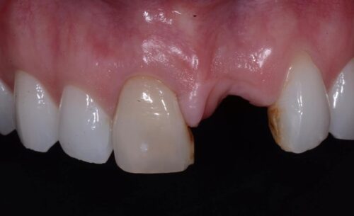 Close-up of the upper front teeth showing a missing central incisor with exposed gum between the neighboring teeth.