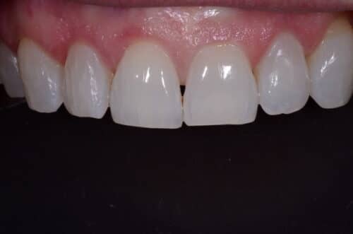 Close-up of upper front teeth showing a small gap between the central incisors and pink gum tissue.