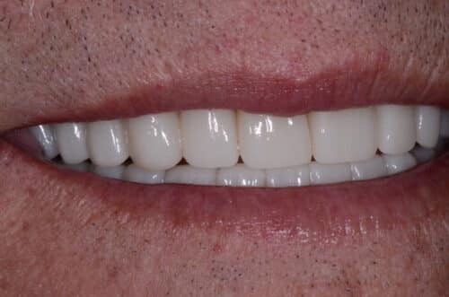 Close-up of a smile showing straight, white teeth and pink lips.