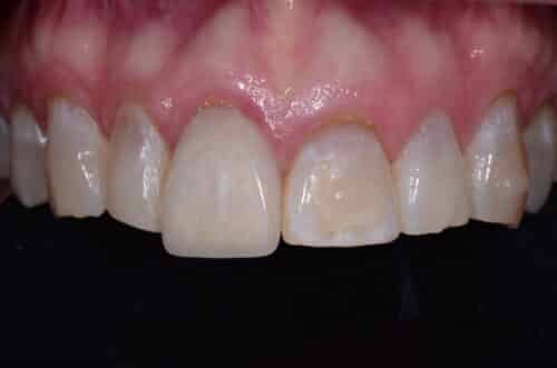 Close-up of front teeth with red, inflamed gums along the gumline.