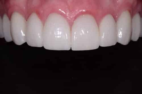 Close-up of upper front teeth and pink gum line in a dental photo.