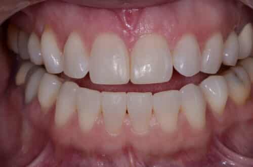Close-up of upper front teeth showing a small gap between the central incisors and pink gums.