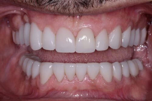 Close-up of a mouth with a full dental prosthesis: evenly aligned, bright white upper and lower teeth on pink gums.