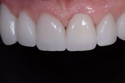Close-up of upper front teeth showing evenly shaped, bright white veneers/crowns along the gum line.