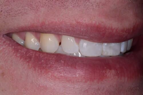 Close-up of a mouth with the upper lip pulled over front teeth; lips are red and slightly chapped.