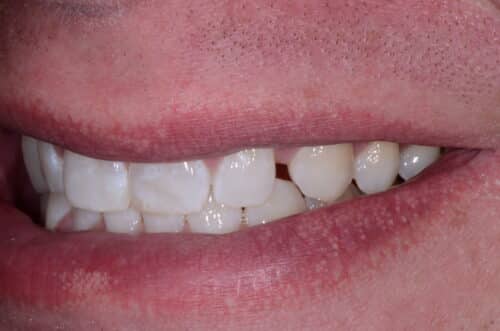 Close-up of a person's mouth with lips partially open, showing the upper row of teeth and pink, irritated lower lip.