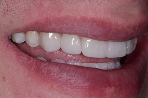 Close-up of a person's mouth with white upper teeth visible and pink lips framing the smile.