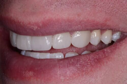 Close-up of a smile showing red, chapped perioral lips with visible teeth in the background.