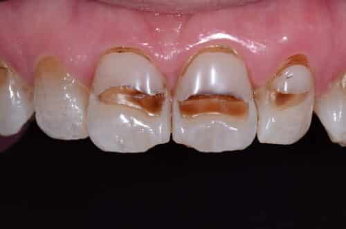 Close-up of upper front teeth with extensive brown decay, chipping, and pink gums behind them.