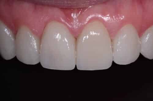 Close-up of the lower front teeth and pink gum tissue, showing a small gap between the two central incisors and smooth enamel surfaces.