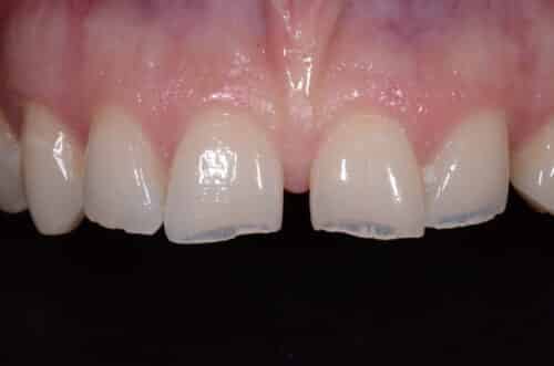 Close-up of the upper front teeth showing a small gap (diastema) between the two central incisors and pink gum tissue above.