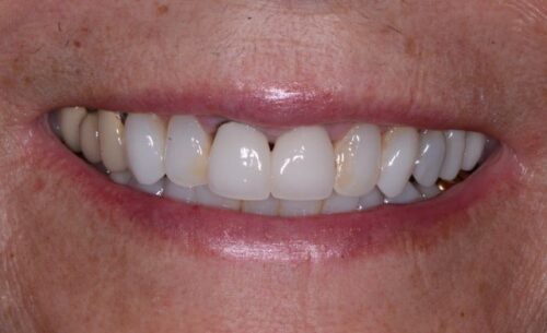 Close-up of a smiling mouth with visible white teeth and pink lips.