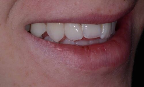 Close-up of a smile showing the upper row of white teeth with pink lips and skin surrounding them.
