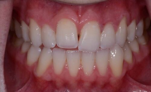 Close-up of a mouth showing upper and lower teeth with pink gums; mild crowding of the front teeth.