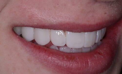 Close-up of a smile showing bright, evenly aligned teeth with pink lips nearby.